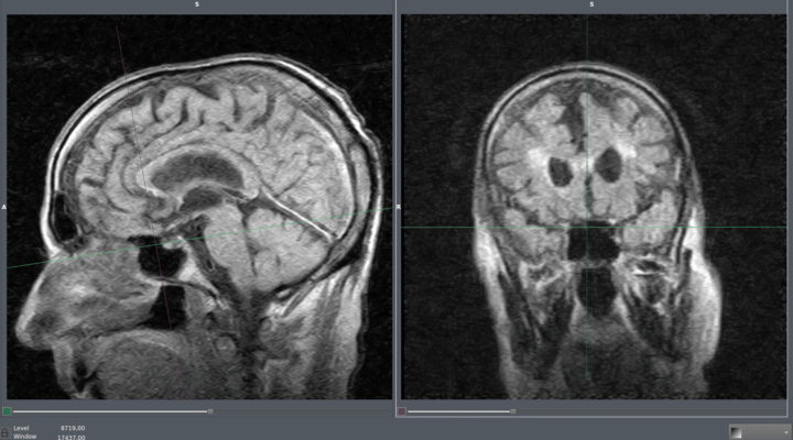 Resonancia Magnética de paciente de avanzada edad que muestra hiperintensidades en materia blanca y atrofia cerebral, compatible con enfermedad de pequeño vaso. (C) 2024 CC BY-SA Dr. Luis Falcón